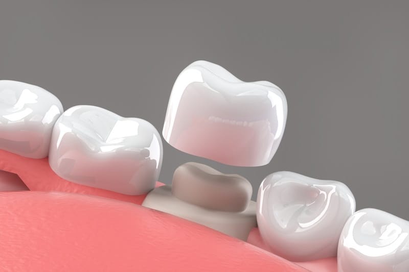 teeth cap